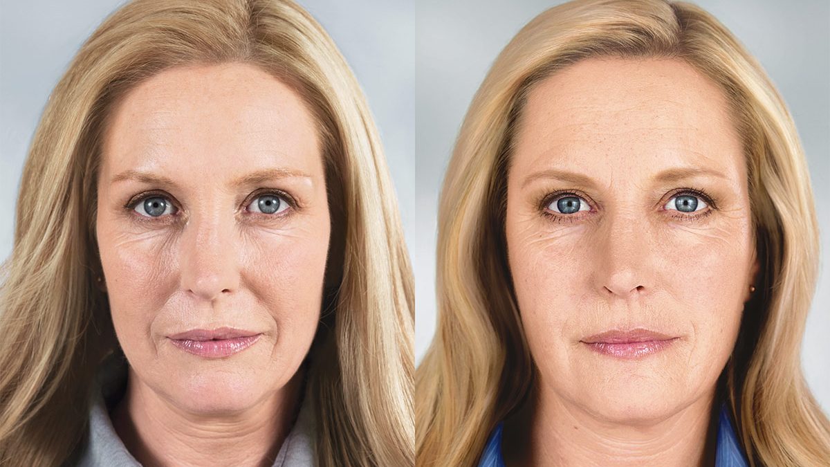 Sculptra: el tratamiento que estimula colágeno de forma natural